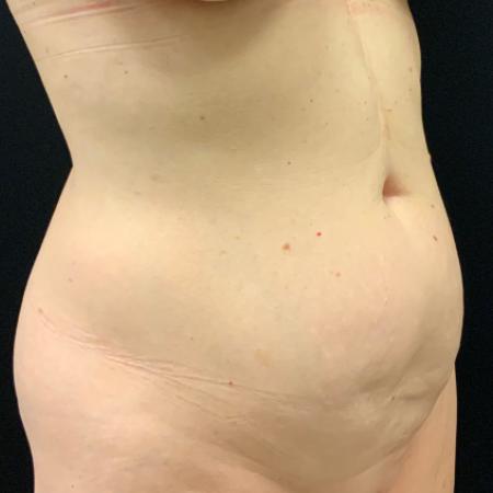 Before image 5 Case #105241 - Mini Abdominoplasty with Liposuction