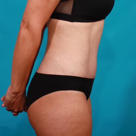 After image 3 Case #104071 - Tummy Tuck with SAL