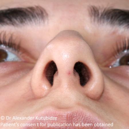 Before image 6 Case #105221 - Primary Septorhinoplasty