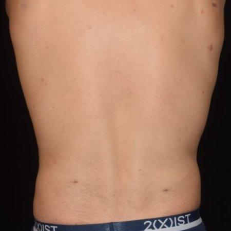 After image 1 Case #105266 - Male Liposuction