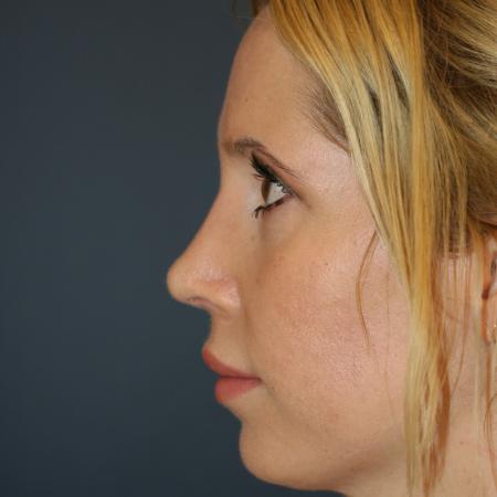 After image 3 Case #105341 - Revision Septo-Rhinoplasty