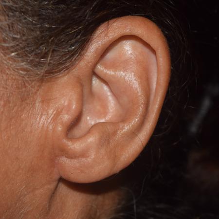 After image 2 Case #105251 - Earlobe Reduction & Repair