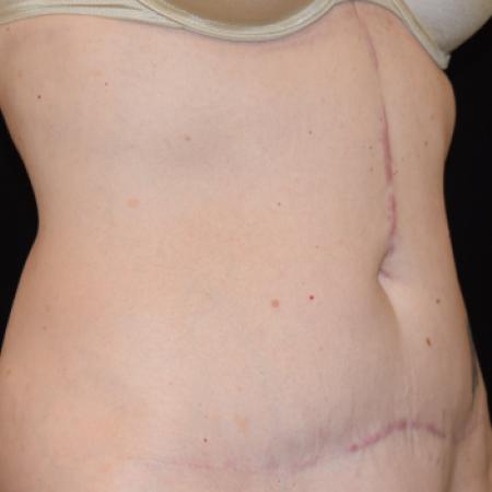 After image 5 Case #105241 - Mini Abdominoplasty with Liposuction