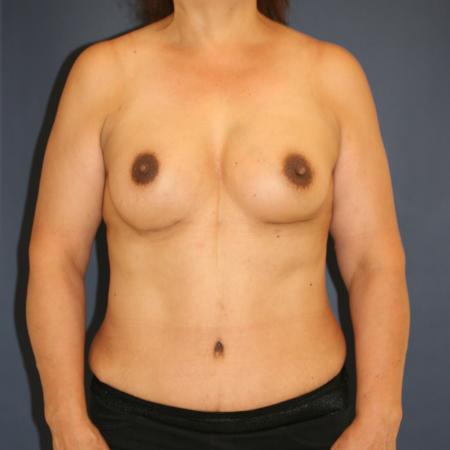 After image 1 Case #105346 - Mommy Makeover