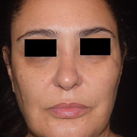 After image 2 Case #105261 - Mole Excision
