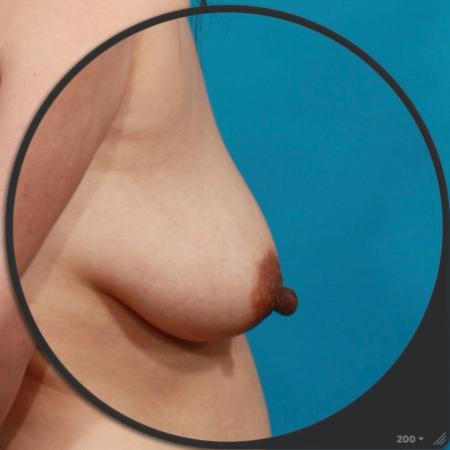 Before image 4 Case #103991 - BL / BA / Nipple Reduction