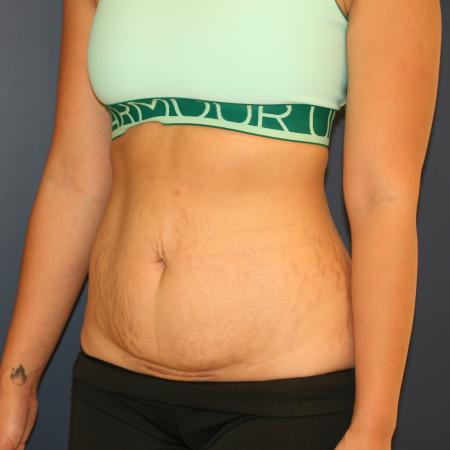 Before image 4 Case #105371 - Abdominoplasty (Tummy Tuck)