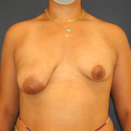 Before image 1 Case #105306 - Breast Asymmetry