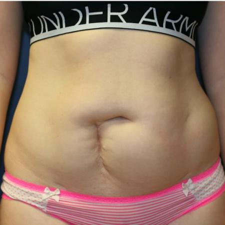 Before image 1 Case #105491 - Fitness Tummy Tuck (Abdominoplasty)