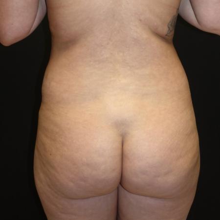 Before image 1 Case #105571 - BBL