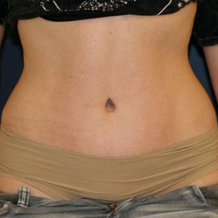 After image 1 Case #105451 - Fitness Tummy Tuck (Abdominoplasty)