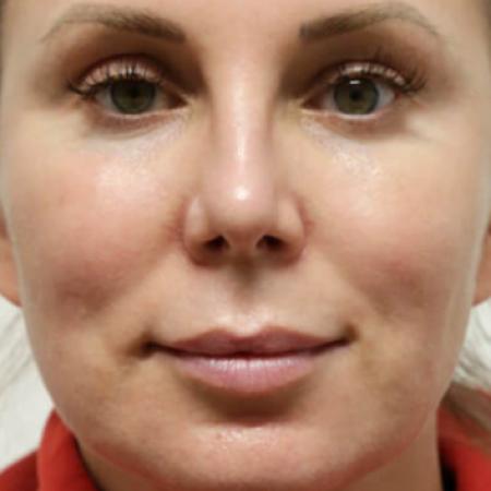 After image 1 Case #105521 - Female Eyelid Lift