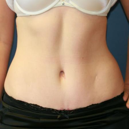 After image 1 Case #105491 - Fitness Tummy Tuck (Abdominoplasty)