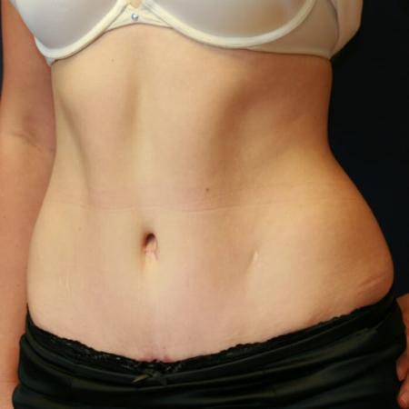 After image 2 Case #105491 - Fitness Tummy Tuck (Abdominoplasty)