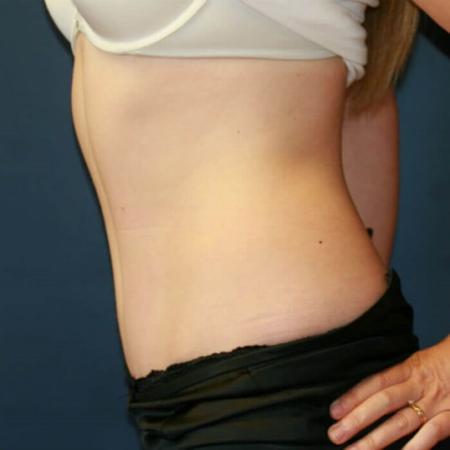 After image 3 Case #105491 - Fitness Tummy Tuck (Abdominoplasty)