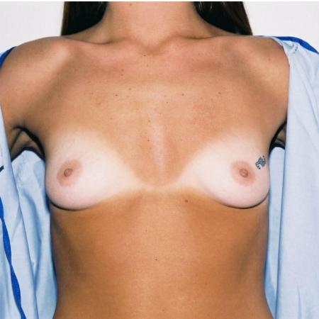 Before image 1 Case #105501 - Breast Augmentation