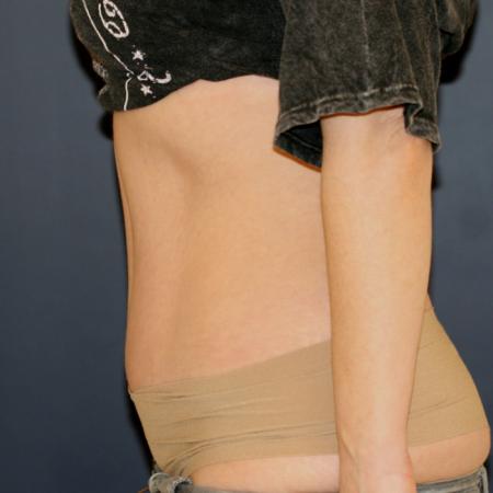 After image 3 Case #105451 - Fitness Tummy Tuck (Abdominoplasty)