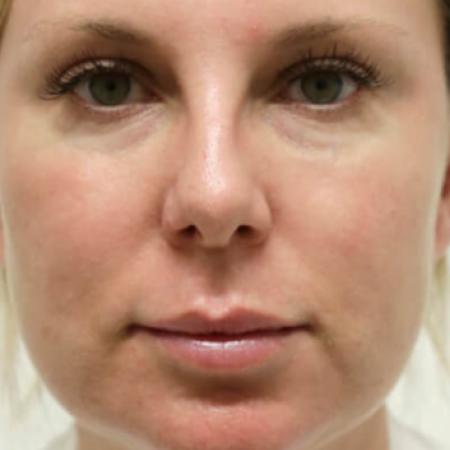 Before image 1 Case #105521 - Female Eyelid Lift