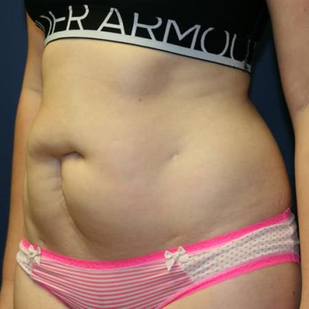 Before image 2 Case #105491 - Fitness Tummy Tuck (Abdominoplasty)