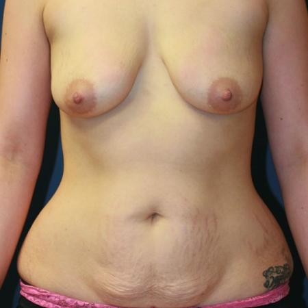 Before image 1 Case #105401 - Mommy Makeover
