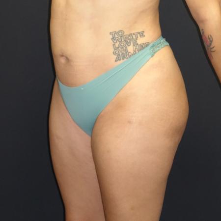 After image 1 Case #106026 - Brazilian Butt Lift
