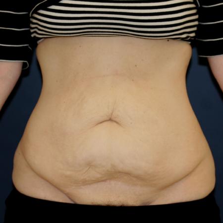 Before image 1 Case #106121 - Tummy Tuck (Abdominoplasty)