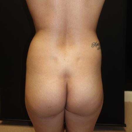 Before image 3 Case #106026 - Brazilian Butt Lift