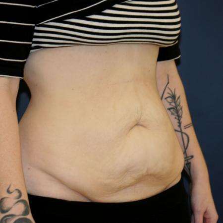 Before image 2 Case #106121 - Tummy Tuck (Abdominoplasty)