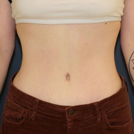 After image 1 Case #106121 - Tummy Tuck (Abdominoplasty)