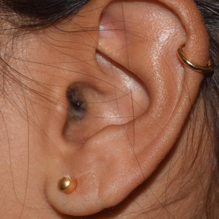 After image 1 Case #106226 - In Office Bilateral Earlobe Repair Procedure