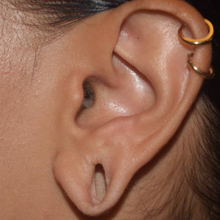 Before image 1 Case #106226 - In Office Bilateral Earlobe Repair Procedure