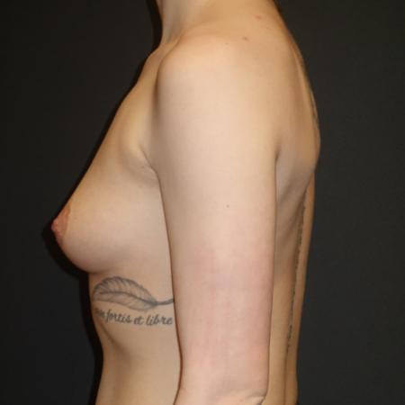 Before image 3 Case #106006 - Breast Augmentation