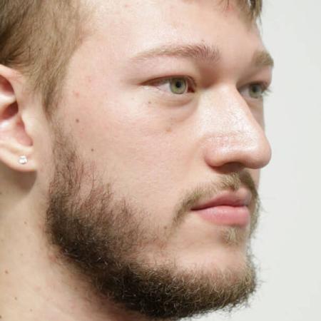 Before image 2 Case #106486 - Male Face Transformation