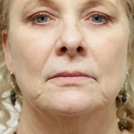 Before image 1 Case #106591 - Female Total Face Rejuvenation