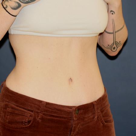 After image 2 Case #106121 - Tummy Tuck (Abdominoplasty)