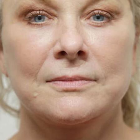 After image 1 Case #106591 - Female Total Face Rejuvenation
