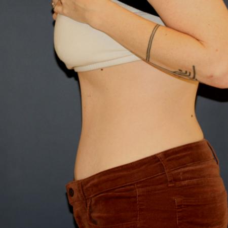 After image 3 Case #106121 - Tummy Tuck (Abdominoplasty)