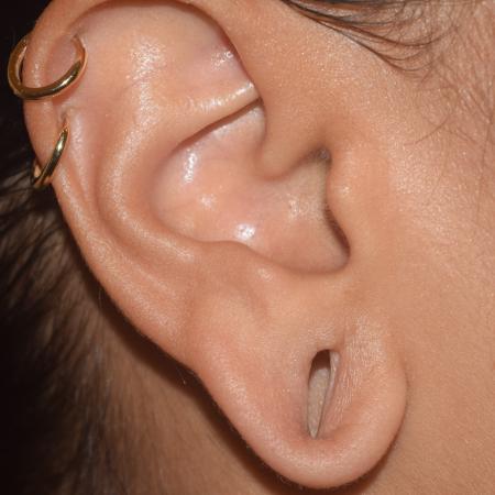 Before image 2 Case #106226 - In Office Bilateral Earlobe Repair Procedure