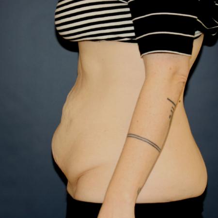 Before image 3 Case #106121 - Tummy Tuck (Abdominoplasty)