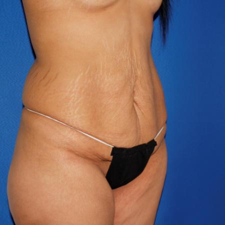 Before image 2 Case #106996 - Abdominoplasty with Liposuction Flanks