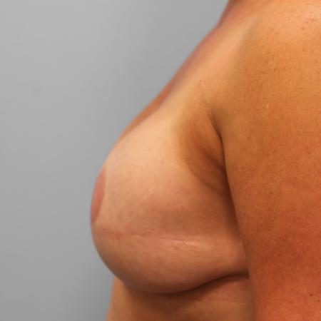 After image 3 Case #107241 - Breast Reconstruction