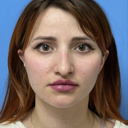 Before image 1 Case #106676 - 29 year old - Open Rhinoplasty - 1 month post op
