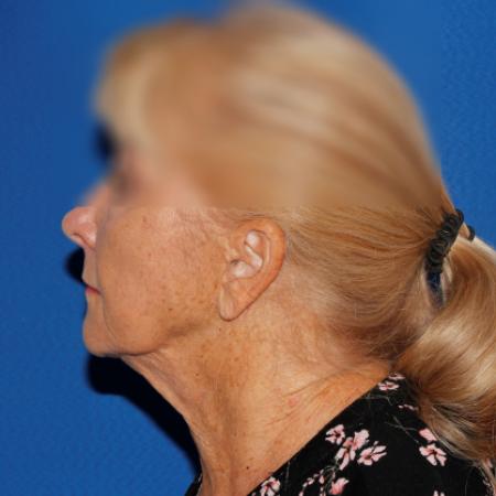 Before image 3 Case #107381 - Secondary Facelift