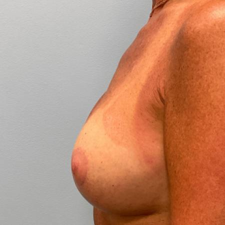 After image 3 Case #107286 - Breast Augmentation