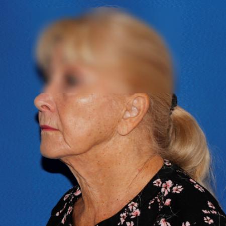 Before image 2 Case #107381 - Secondary Facelift