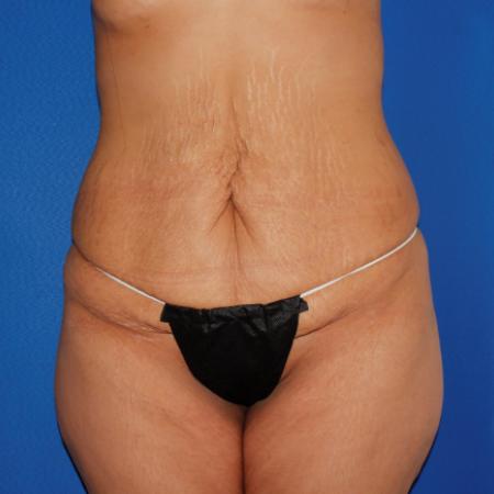 Before image 1 Case #106996 - Abdominoplasty with Liposuction Flanks