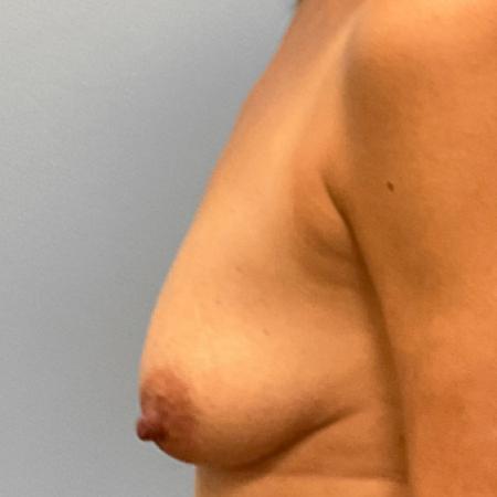 Before image 3 Case #107271 - Breast Augmentation