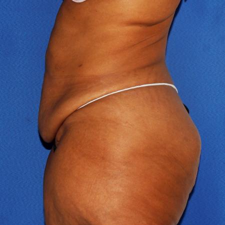 Before image 3 Case #107186 - Tummy tuck with liposuction of flanks.
