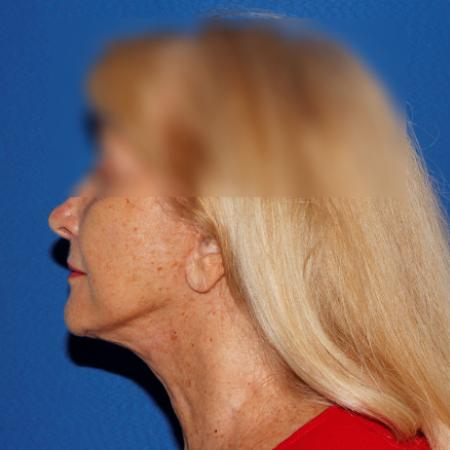 After image 3 Case #107381 - Secondary Facelift