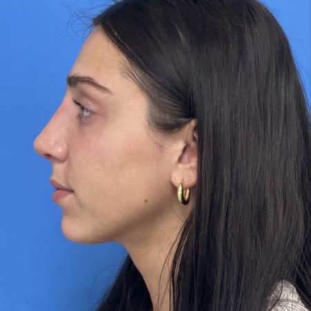 After image 3 Case #107301 - Rhinoplasty